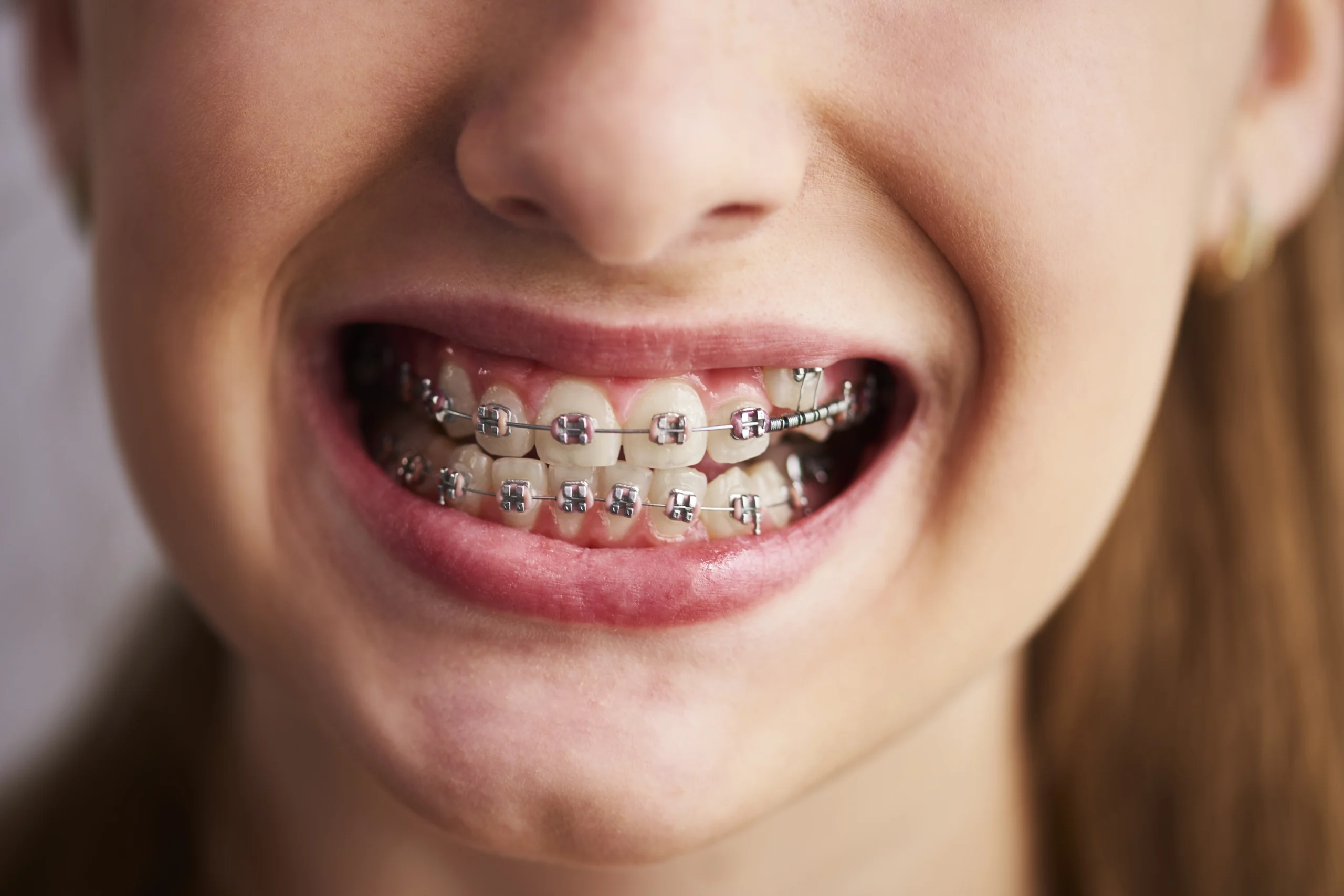 teeth with braces