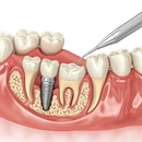Implant dentaire bouge