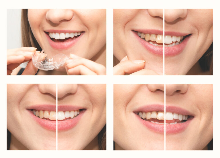 Teeth whitening, smile before after bleaching