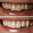 Tout savoir sur 100 Santé Dentaire Implant