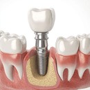 Durée de vie implant dentaire