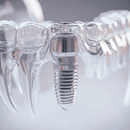 Implantation dentaire prix France