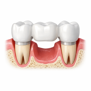 Bridge dentaire