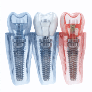 comment se passe la pose d'un implant dentaire